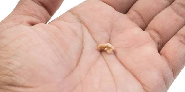 Why Do You Get Tonsil Stones 