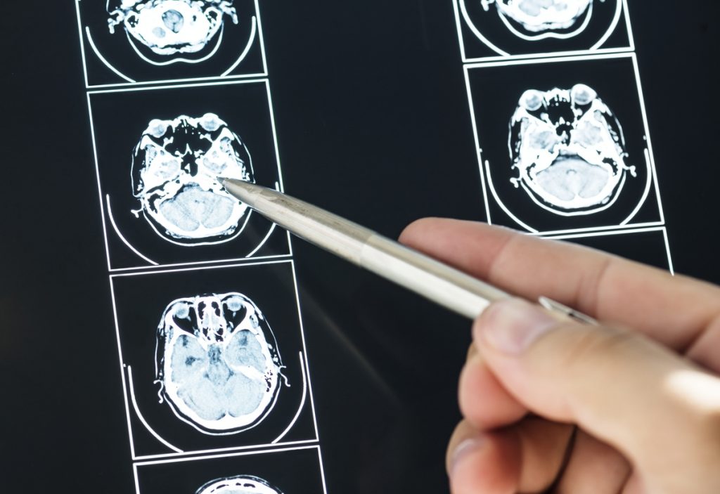 Provera and Meningioma