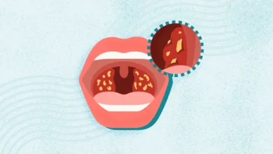 Why Do You Get Tonsil Stones